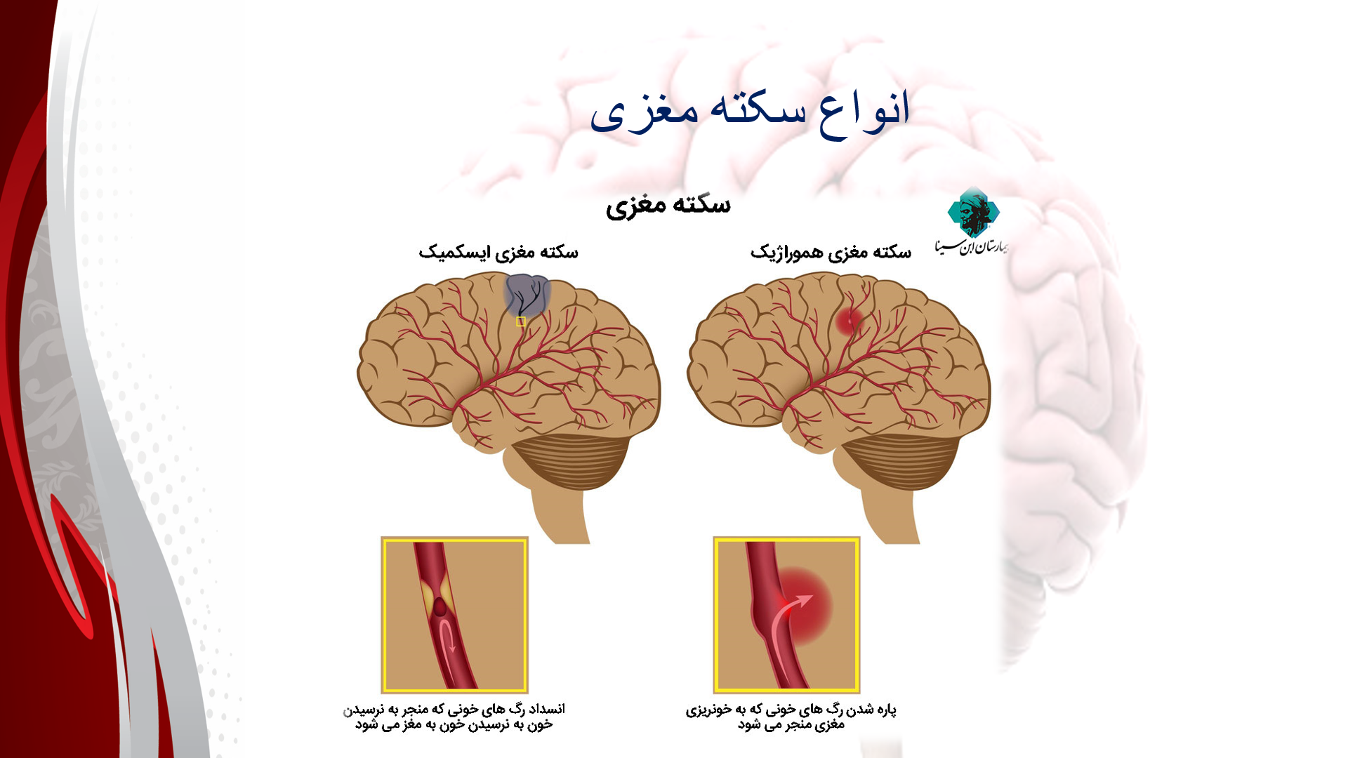 پاورپوینت در مورد سکته مغزی 